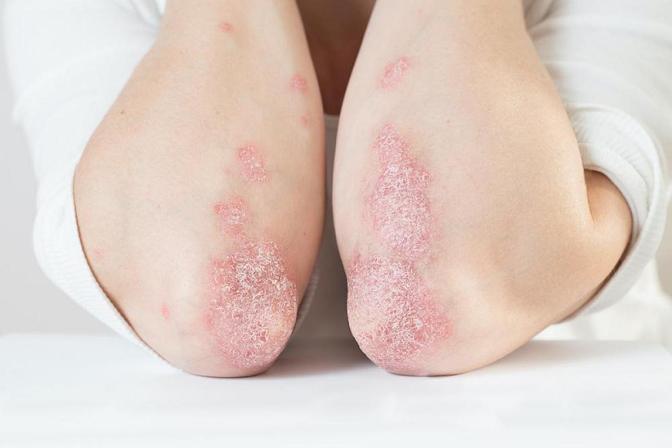 Psoriaz nədir və necə müalicə olunur? 
