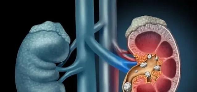 Mütəxəssisdən xəbərdarlıq: Sidik yolları infeksiyalarına qarşı 