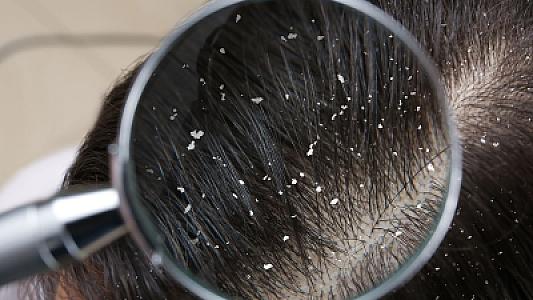 Kəpəklə necə mübarizə aparmalı? – Dermatoloqdan 