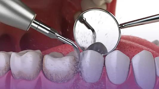 Diş daşı təmizliyi niyə vacibdir? –