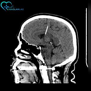 Azərbaycanda qadının beynində iynə aşkarlandı -