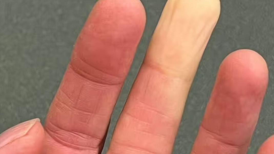 Əllər və ayaqlarda rəng dəyişməsi yalnız 