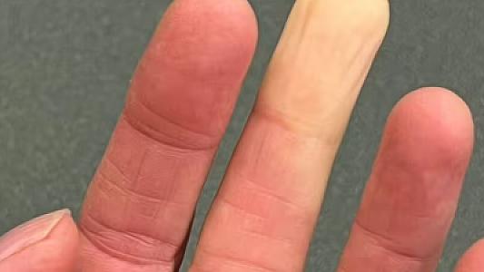 Əllər və ayaqlarda rəng dəyişməsi yalnız 