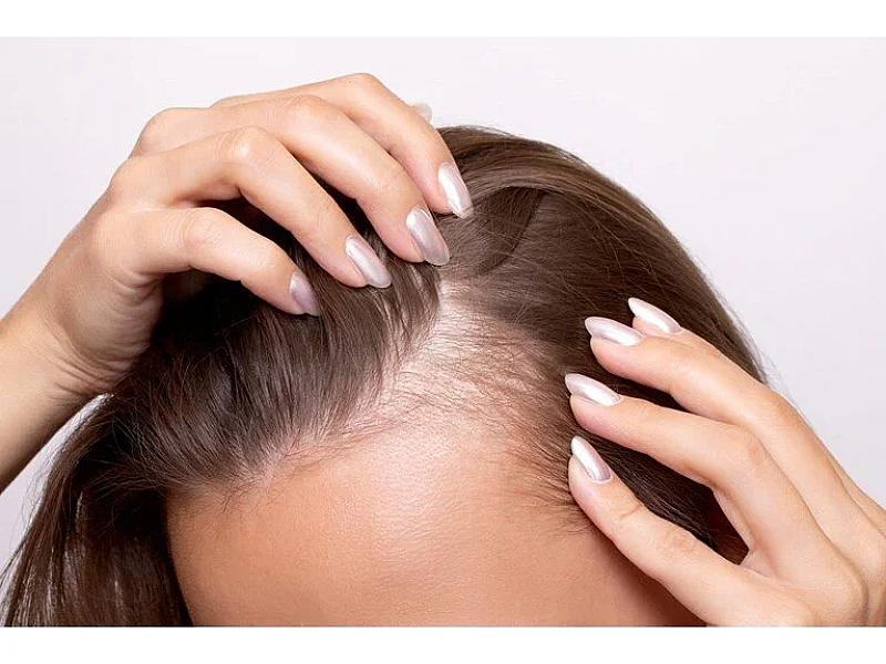  Dermatoloq açıqladı: Mövsümi saç tökülməsi 