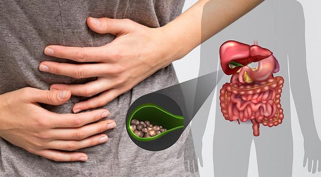 Öd daşları təhlükə yaradır: Vaxtında 