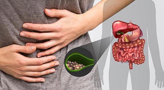 Öd daşları təhlükə yaradır: Vaxtında 