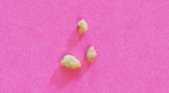 Boğaz daşı xəstəliyi: Səbəblər, simptomlar və 