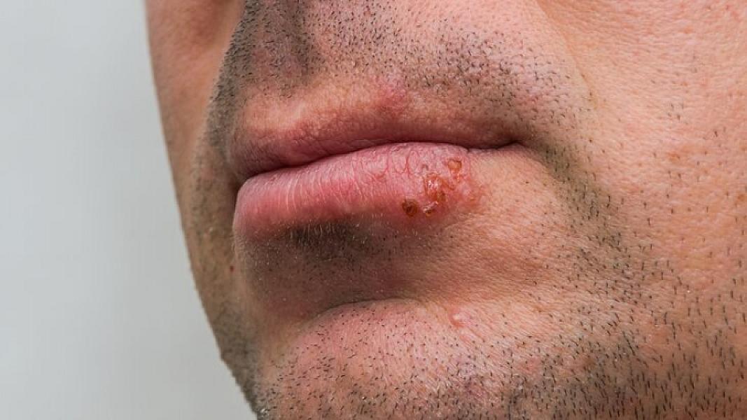 Herpes görmə itkisinə və ağır  fəsadlara