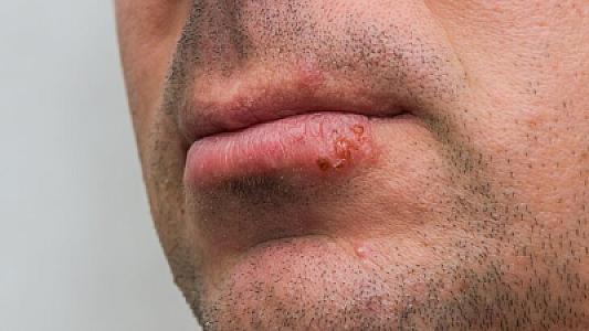 Herpes görmə itkisinə və ağır  fəsadlara