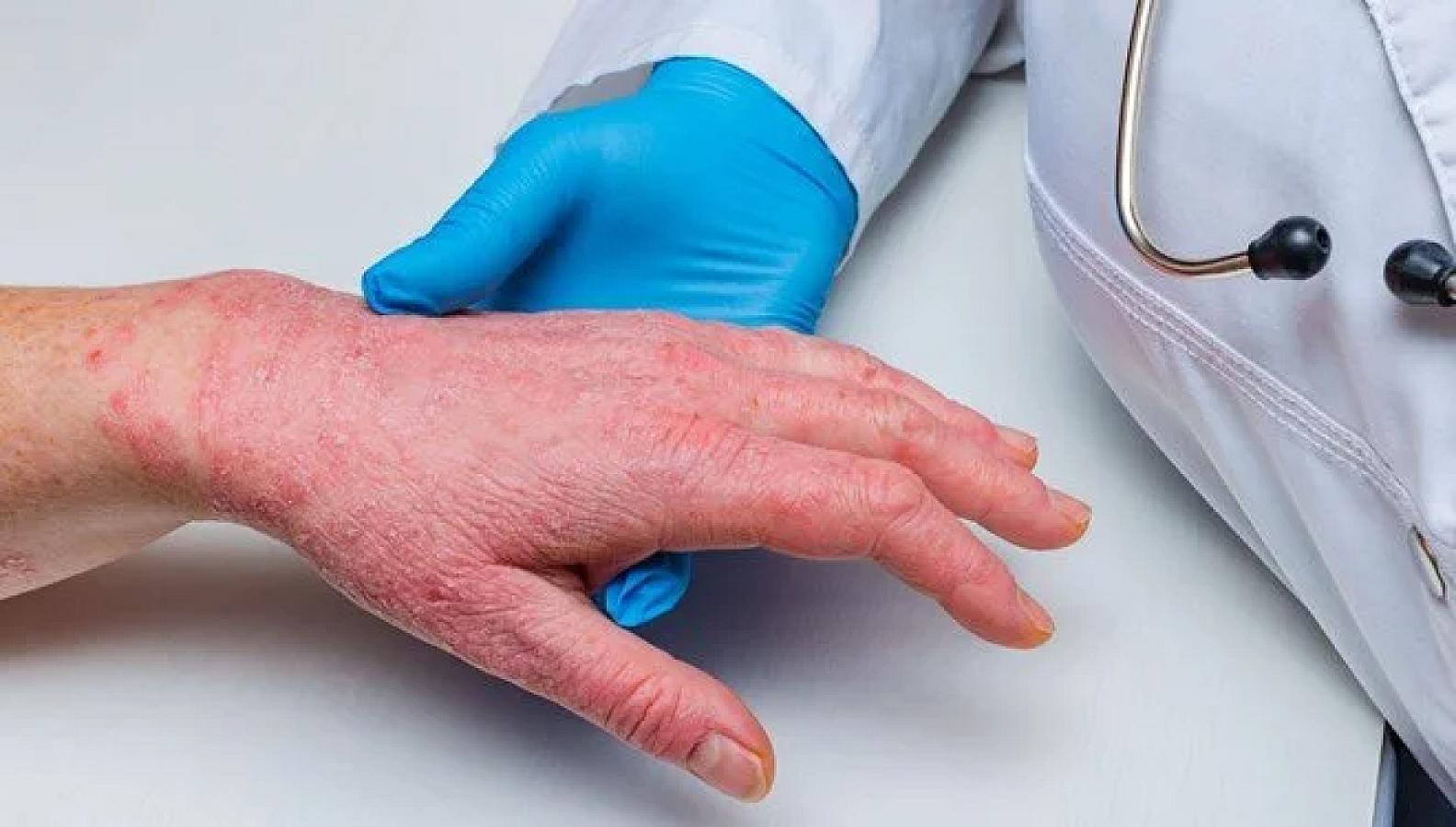 Sedef xəstəliyi nədir və necə 