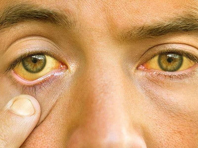 Hepatit A virusunun əlamətləri hansılardır?