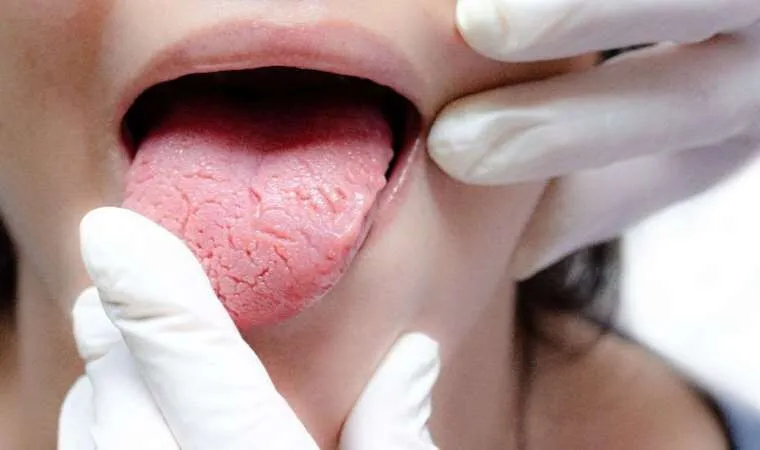 Dil rəngi xəstəliklərin