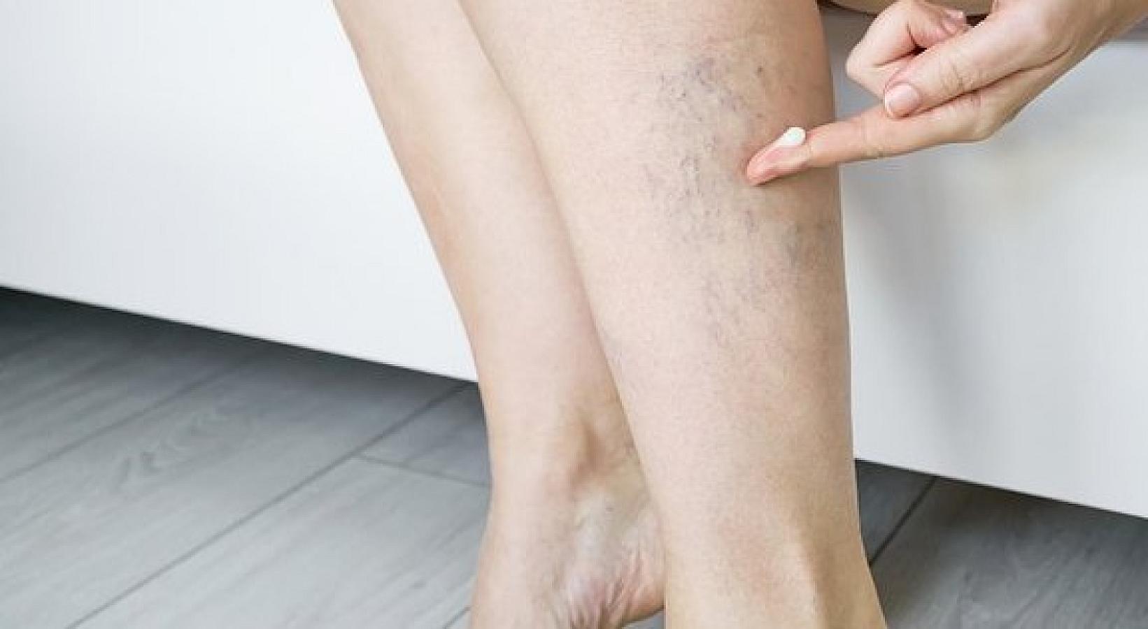 Həkim tromboza səbəb olan