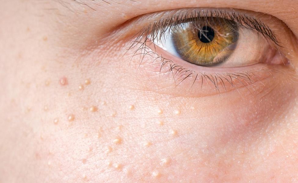 Üzdə görünən bu dəyişiklik yüksək xolesteroldan