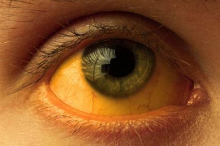 Qızılcadan sonra sarılıq dalğası gəlir? -