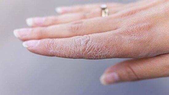 Qışda dəriyə zərər vuran 3 səbəb açıqlanıb: