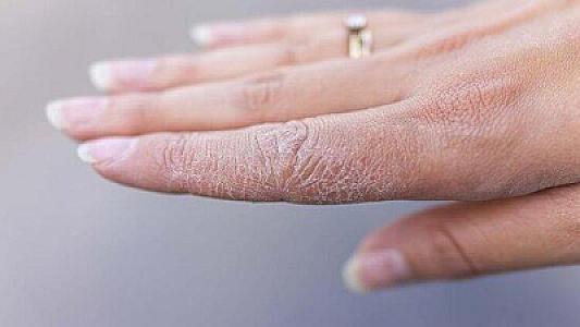 Qışda dəriyə zərər vuran 3 səbəb açıqlanıb: