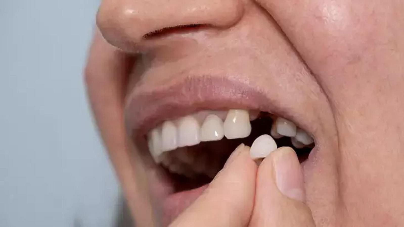 Diş itkisi yalnız estetik problem deyil: