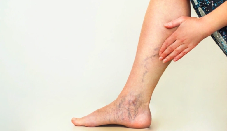 Varikoz damarlarının erkən mərhələdə dayandırılması üçün