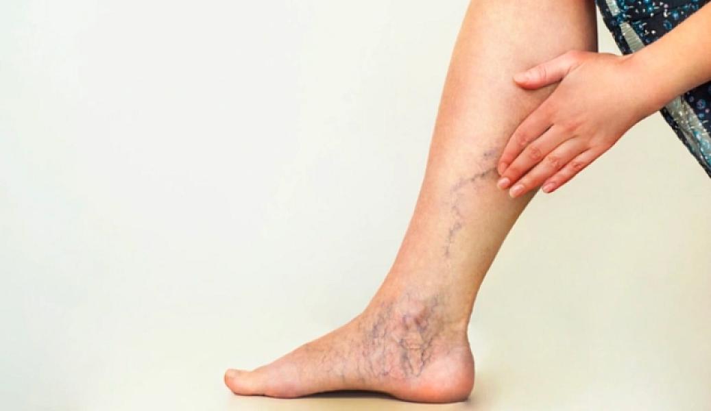 Varikoz damarlarının erkən mərhələdə dayandırılması üçün