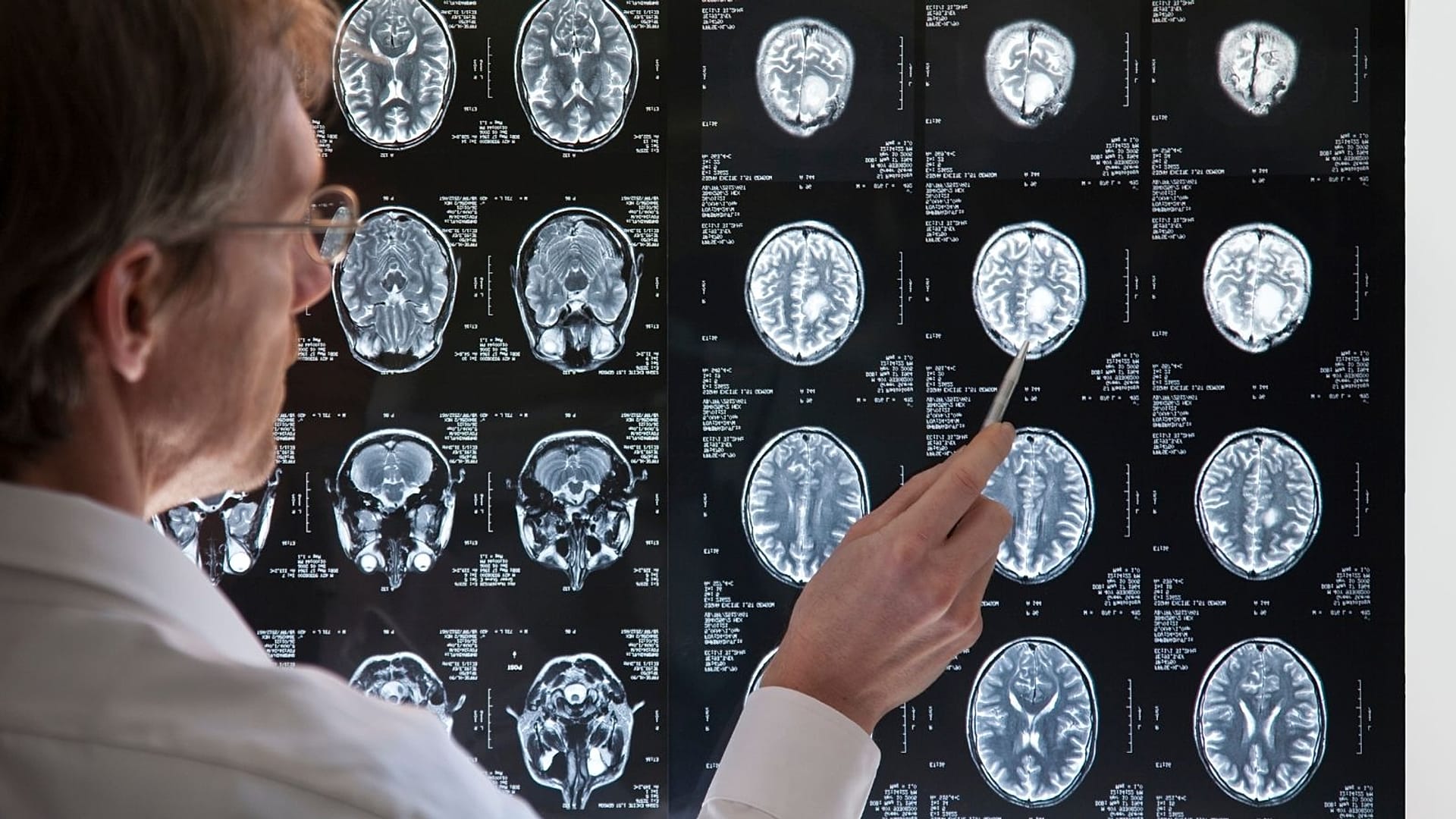 Niyə bəzi beyinlər dəyişikliklərə