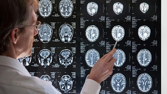 Niyə bəzi beyinlər dəyişikliklərə