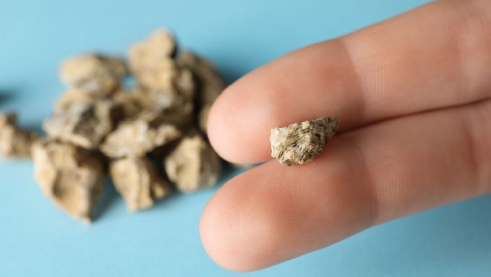 Tibbdə ilk: Böyrək daşlarında