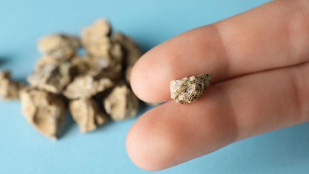 Tibbdə ilk: Böyrək daşlarında - Tibbi xəbərlər