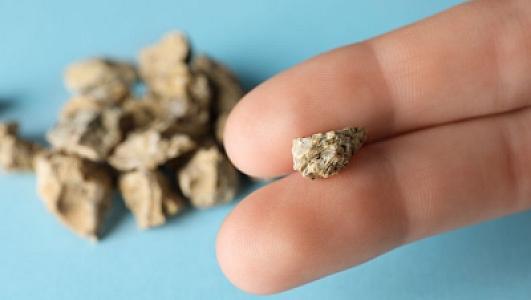 Tibbdə ilk: Böyrək daşlarında