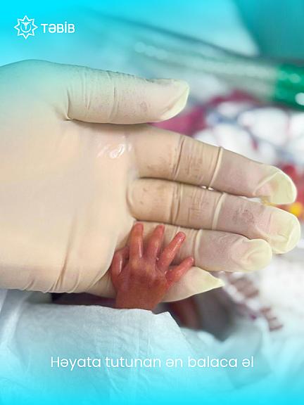 23 həftəsində 540 qram doğulan - 2