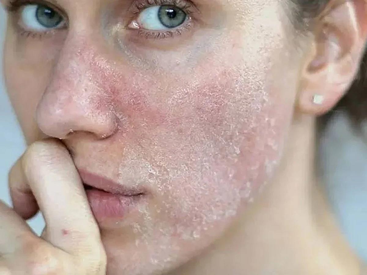 Soyuq havalarda dəridə səpgilərin