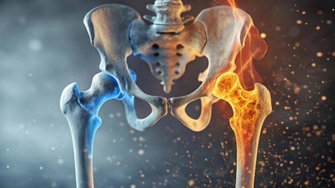 Osteoporoz ən çox hansı sümüklərə zərər verir?