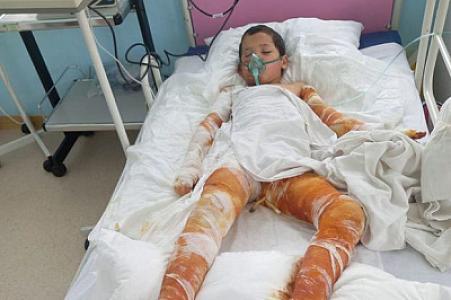 Bütün bədəni yanan Sərxanın anası yardım diləyir: “Müalicələrini davam etdirə bilmirik” - FOTO