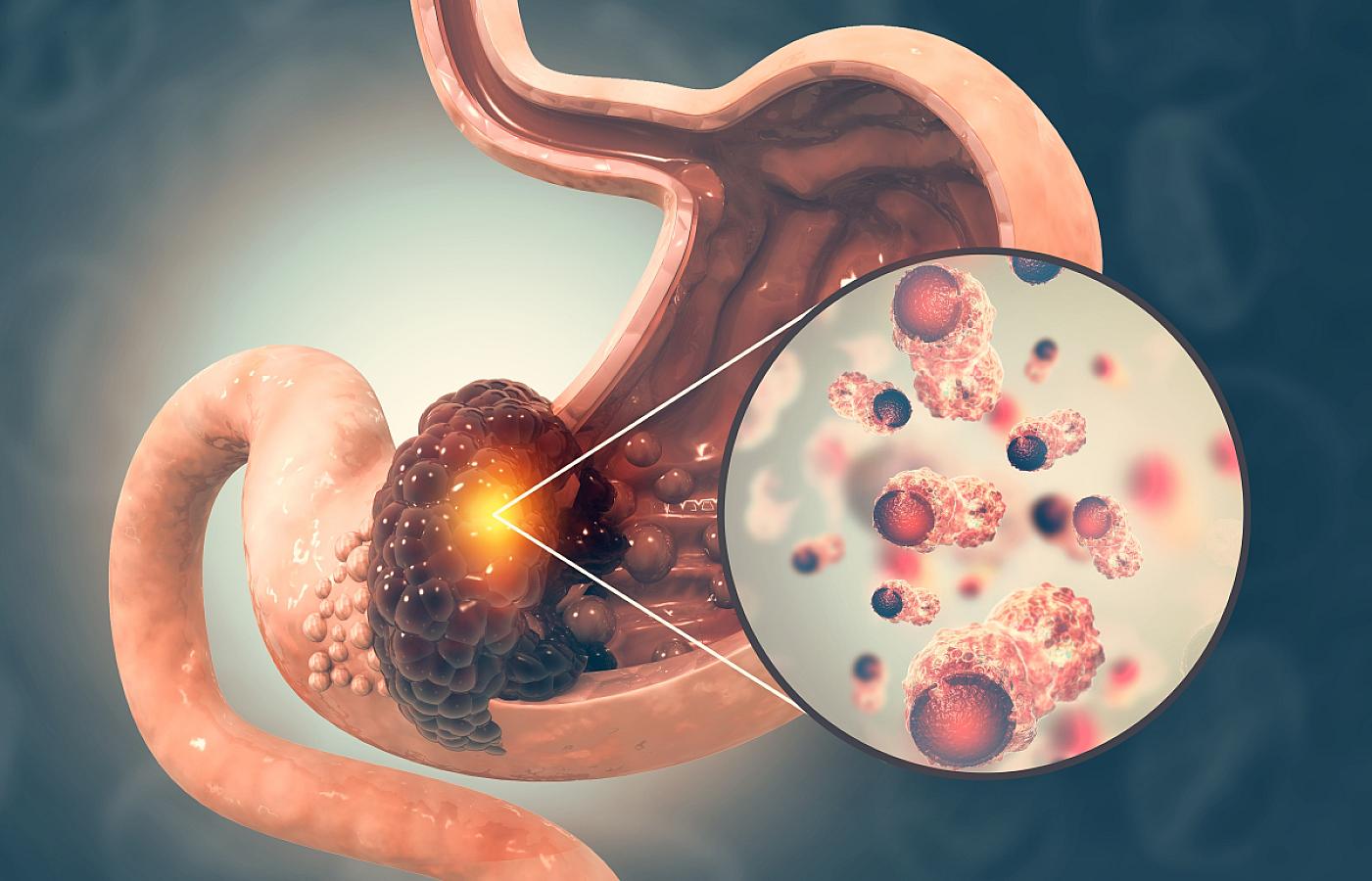 Mədə xərçəngi xəstələrinin