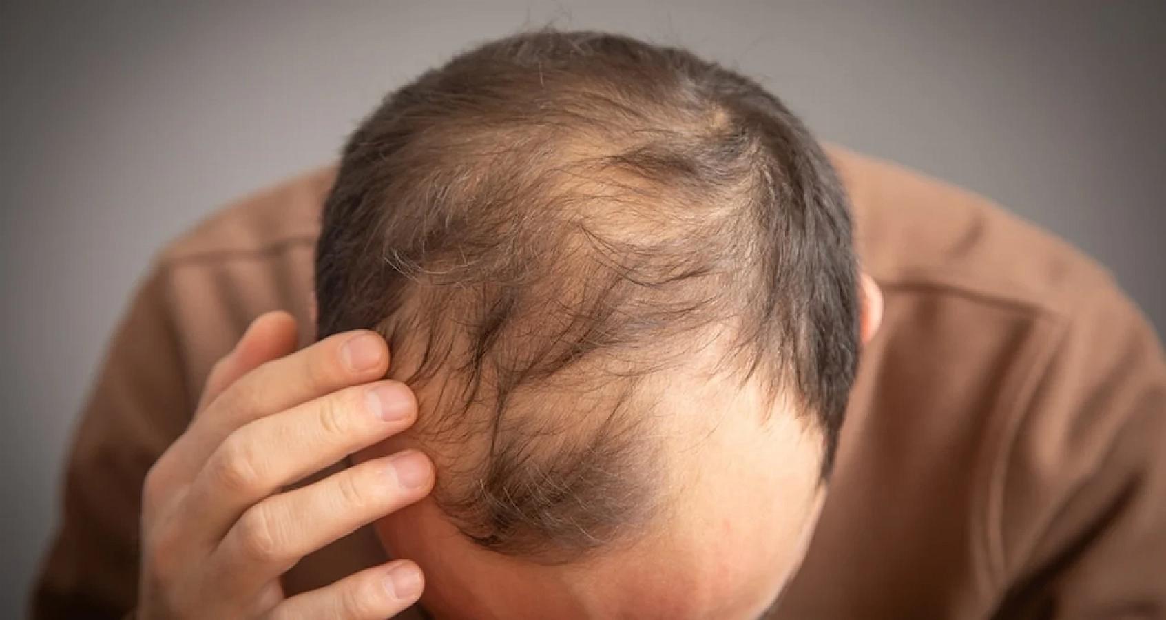 Bu içkilər kişilərdə keçəlliyə