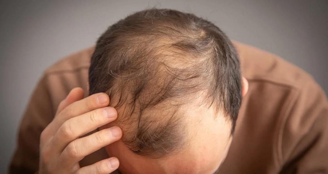 Bu içkilər kişilərdə keçəlliyə