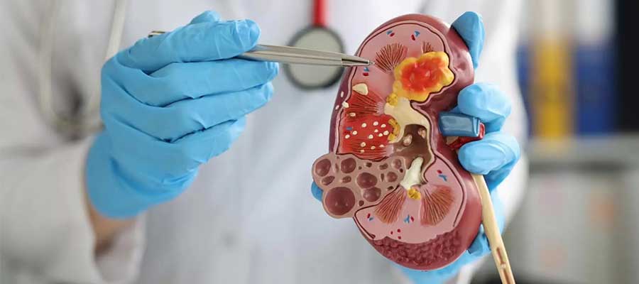 Bu qidalar böyrəkdə daş yaranmasına