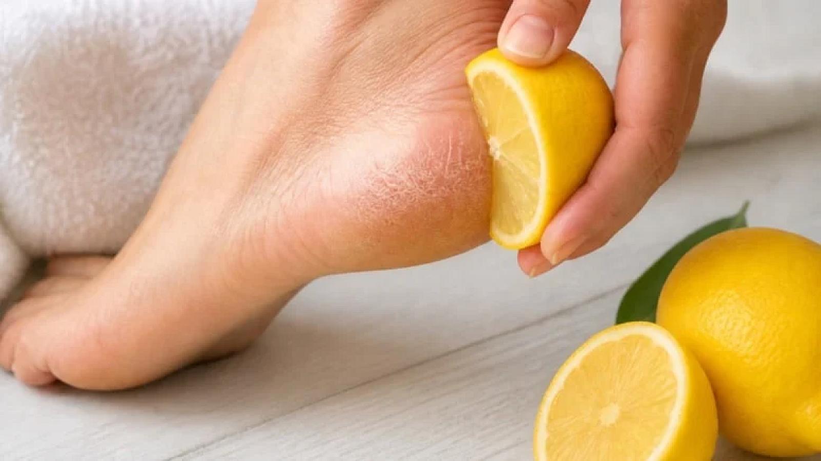 Dabanlarına limon çəkənlər bu problemdən