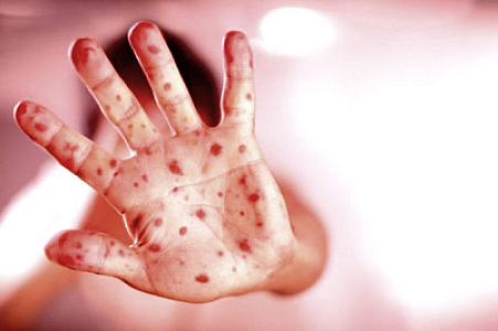 Daha bir azyaşlı qızılcadan ölüb