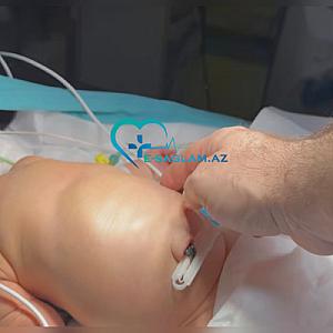 "Azərbaycanda anal dəliyi olmayan körpə doğulub" -