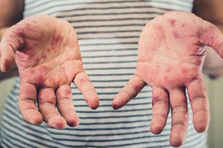 Bir gündə 13, son üç ayda isə 493 nəfər yoluxub: