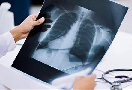 Süni intellekt döş qəfəsinin rentgenoqrafiyasından sağlam bir insanın yaşını