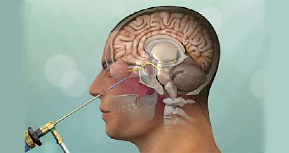 Hipofiz şişləri nədir?