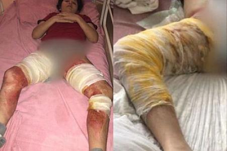 Ağır yanıq xəsarətləri alan qızın yardıma ehtiyacı var: İmkansızlıqdan müalicəsi yarım qalıb -