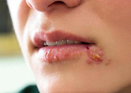 Mövsümlərarası fasildə dodaq herpesindən necə