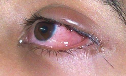 Göz sulanmasının altında yatan gizli təhlükə: