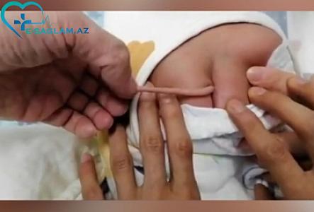 Çində qadın 10 sm quyruğu olan uşaq dünyaya gətirib