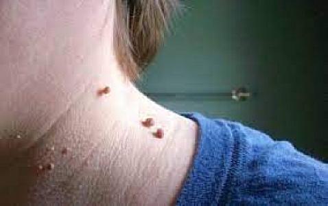 Ət xalının yandırılması xərçəng yaradır?