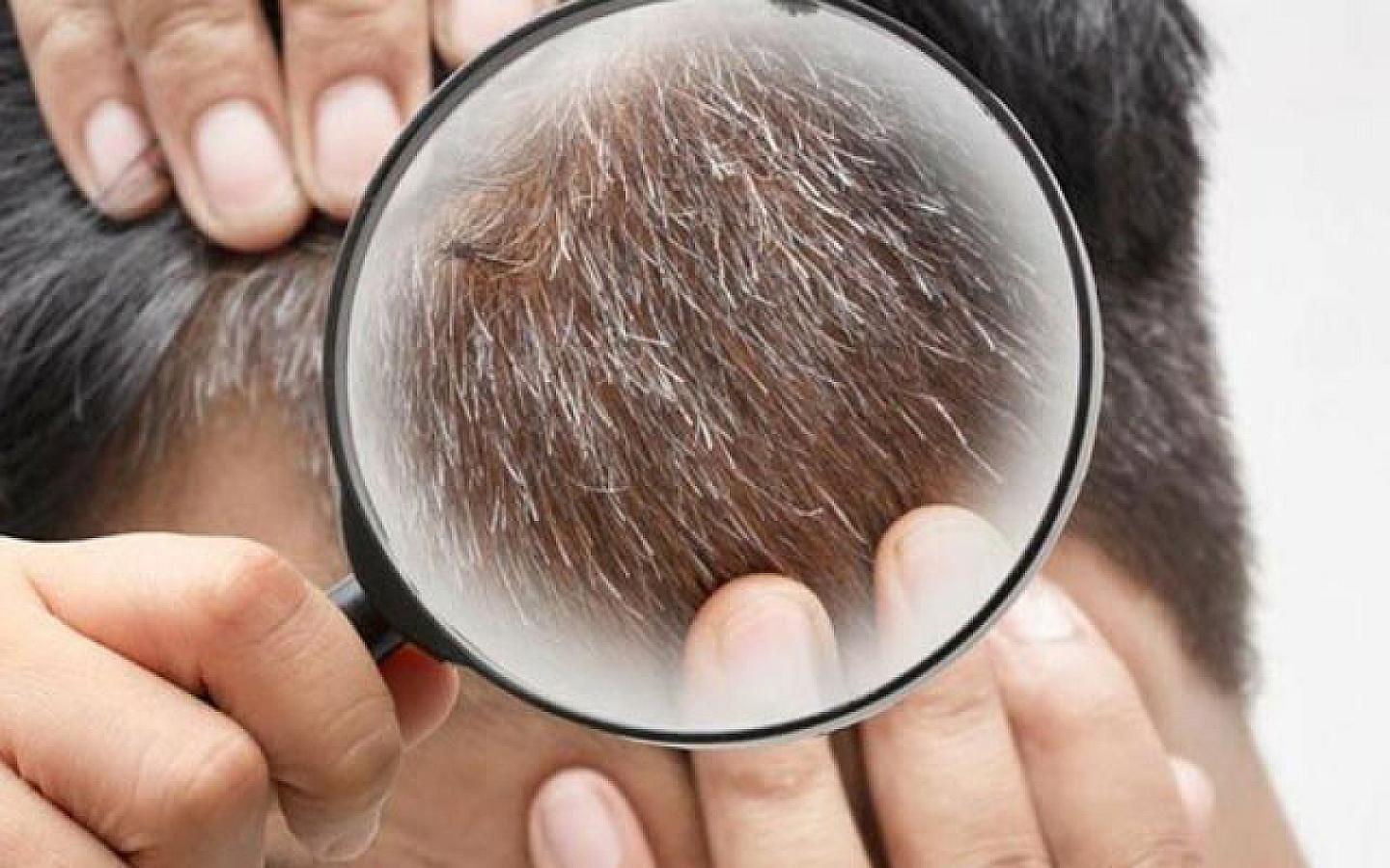 Saçın erkən ağarmasının səbəbi nədir?