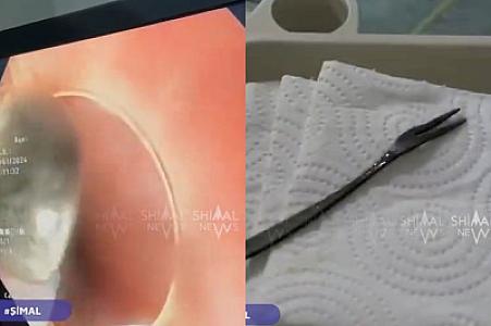 Xaçmaz sakini bir aydan çox mədəsində çəngəllə yaşadı